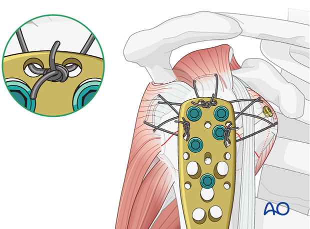 Secure the tendons of the rotator cuff with additional tension band sutures through the small holes in the plate. 