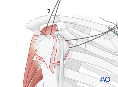 MIO - Screw fixation for Extraarticular 3-part, surgical neck and ...