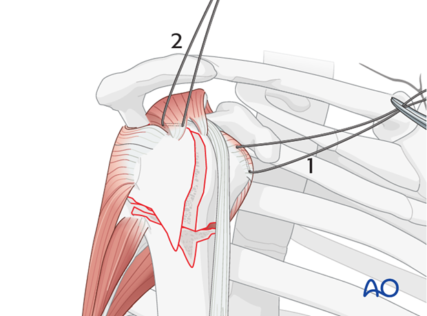 Once the shoulder is reduced, insert sutures into the insertion fibers of subscapularis tendon (1) and the supraspinatus tendon 