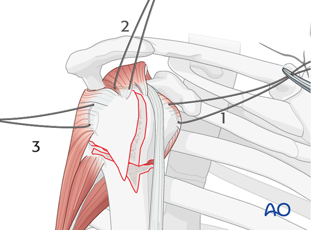 Next, place a suture into the infraspinatus tendon insertion (3).