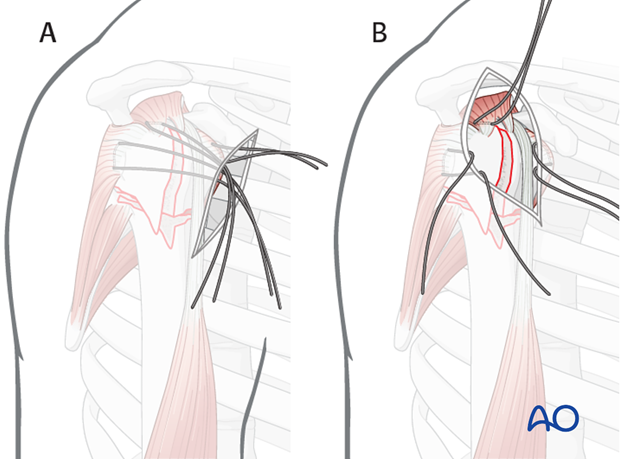 It is easier the further lateral of an approach is used. A) shows an deltopectoral approach and B) an anterolateral approach. 