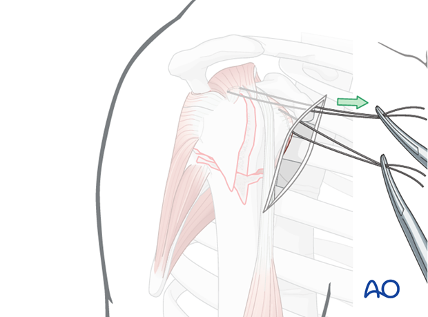 Anterior traction on the supraspinatus tendon helps expose the greater tuberosity and infraspinatus tendon. 
