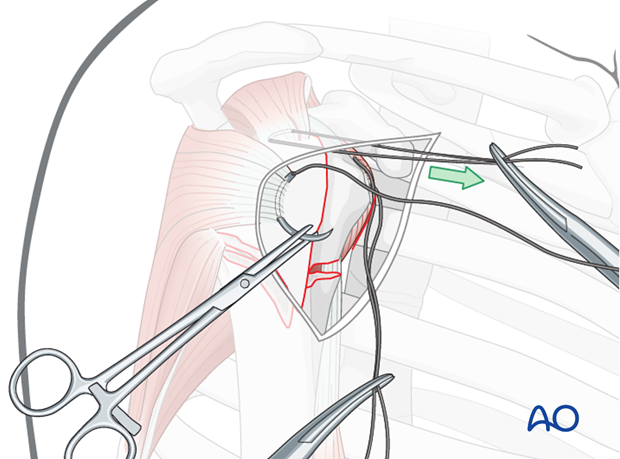 Insert a preliminary traction suture into the visible part of the posterior rotator cuff ...