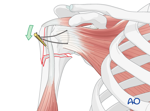 One can use sutures through the rotator cuff, or a joy stick to help reduce the humeral head onto the humeral shaft. 
