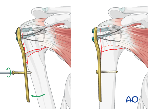 Alternatively, one can fix a plate laterally to the humeral head, reduce the humeral head with the help of a plate.