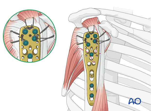 Secure the tendons of the rotator cuff with additional tension band sutures through the small holes in the plate.