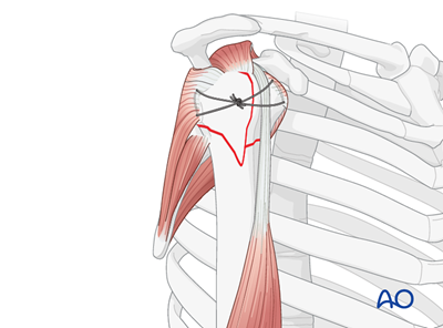 ORIF - Plate fixation for 4-Part, slight displacement, valgus malalignment