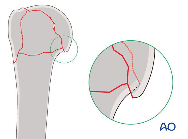 In osteoporotic bone, stability may be increased by leaving medial impaction of the humeral head.