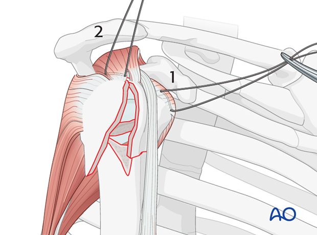 Begin by inserting sutures into the insertion fibers of subscapularis tendon (1) and the supraspinatus tendon (2). 
