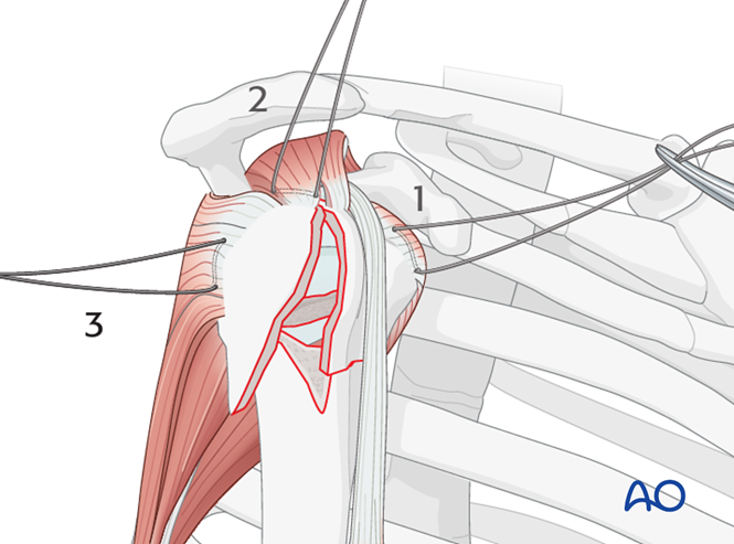 ORIF - Plate fixation for 4-Part, slight displacement, valgus malalignment