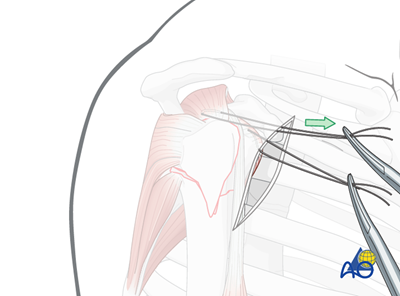 ORIF - Plate fixation for 4-Part, slight displacement, valgus malalignment