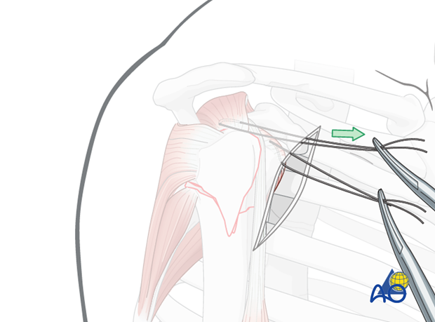 Anterior traction on the supraspinatus tendon helps expose the greater tuberosity and infraspinatus tendon