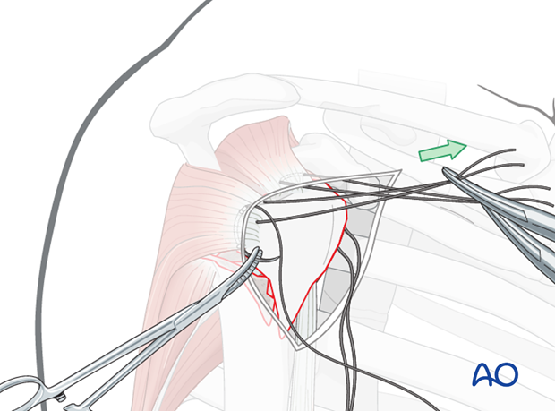 Expose the proper location for a suture in the infraspinatus tendon insertion