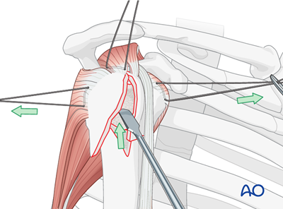 ORIF - Plate fixation for 4-Part, slight displacement, valgus malalignment