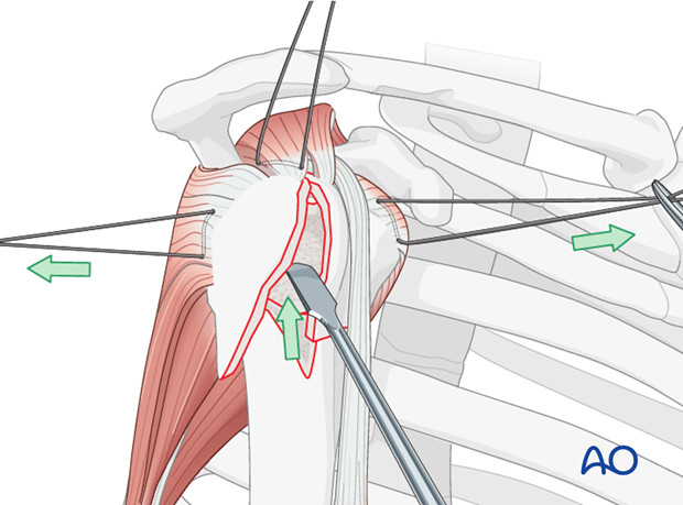 Correct the valgus impaction by elevating the lateral aspect of the humeral head