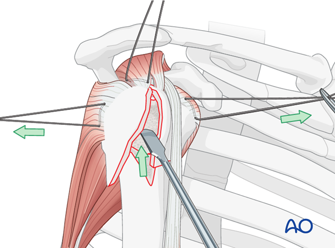 ORIF - Plate fixation for 4-Part, slight displacement, valgus malalignment