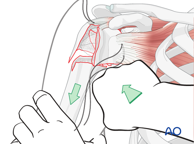  A varus force can be applied to the humeral shaft. This can be achieved by using a fulcrum in the axilla.