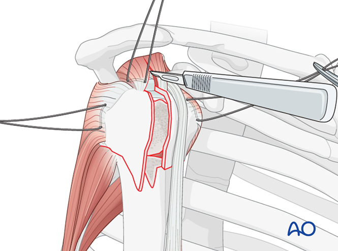 ORIF - Plate fixation for 4-Part, slight displacement, valgus malalignment