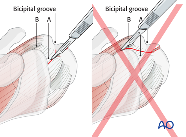 Note: If a cranial extension is needed, it should be carried into the supraspinatus tendon (A) and not into the rotator interval