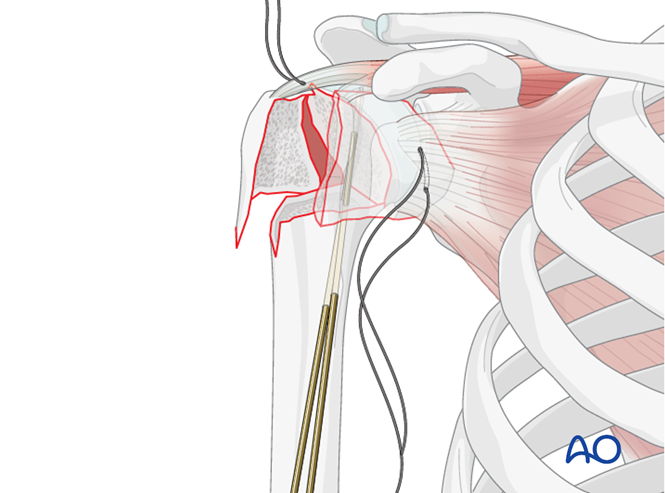 ORIF - Plate fixation for 4-Part, slight displacement, valgus malalignment