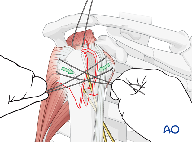 Pull the sutures between the subscapularis and the infraspinatus tendons horizontally ...