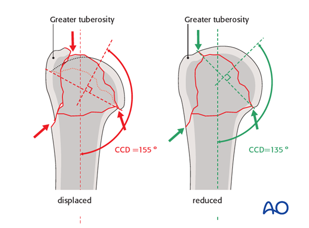 Proper reduction of the major proximal humerus fragments is essential.