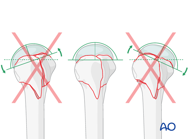 Check that there is no anteversion or excessive retroversion of the humeral head. 