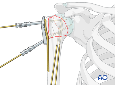 ORIF - Plate fixation for 4-Part, slight displacement, valgus malalignment