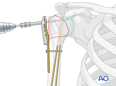 ORIF - Plate fixation for 4-Part, slight displacement, valgus malalignment