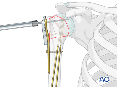 ORIF - Plate fixation for 4-Part, slight displacement, valgus malalignment