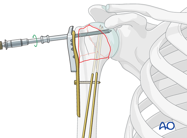 Insert a locking-head screw through the screw sleeve into the humeral head.