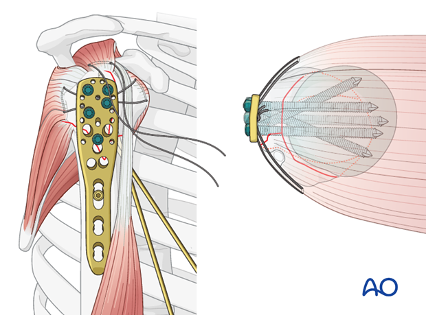 Place a sufficient number of screws (often 5) into the humeral head.