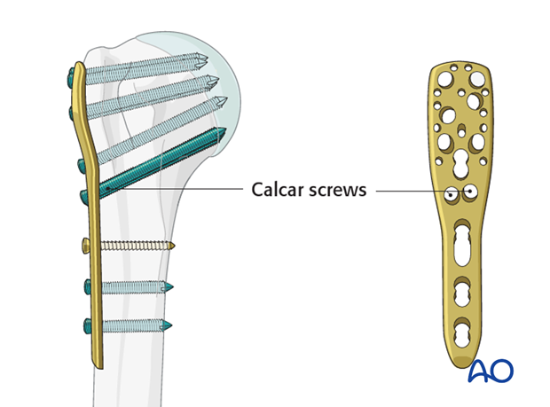 It is strongly recommended to use “calcar screws” in all varus displaced fractures, especially, if there is medial fragmentation