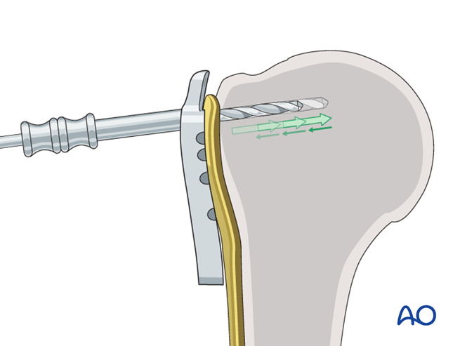 ORIF - Plate fixation for Extraarticular 3-part, surgical neck and ...