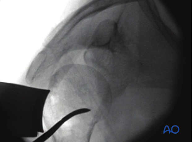 This intraoperative x-ray (AP of the proximal humerus) shows the humeral head reduced with a periosteal elevator.