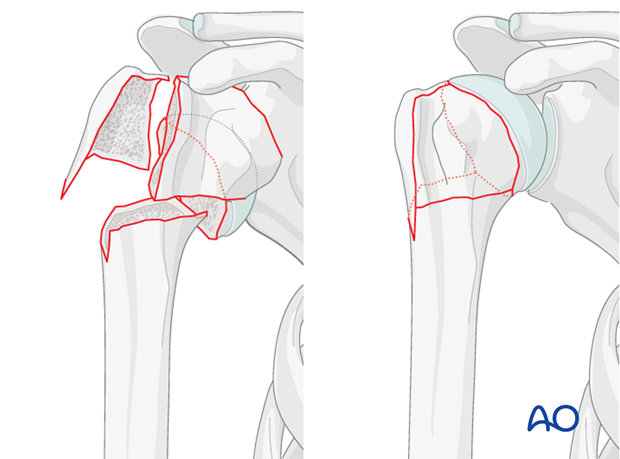 Elimination of the varus deformity of the humeral head is key in this procedure.