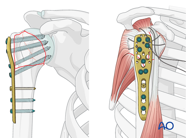 In order to stabilize the humeral head appropriately, sufficient calcar support (screws) is necessary.