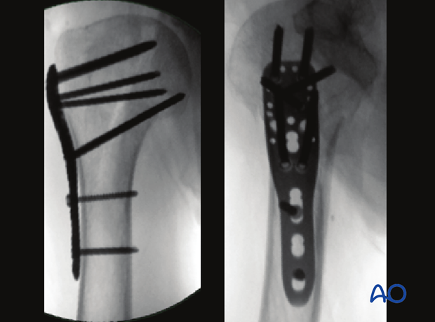 Intraoperative C-arm views