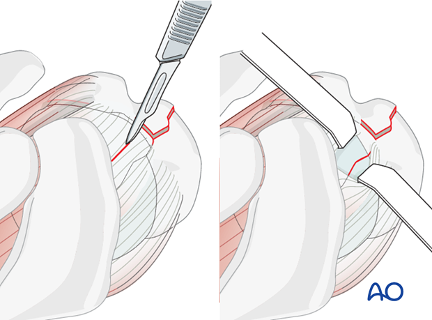 The sagittal head split fracture line is typically not visible since it is covered by the rotator cuff. Since a step-less ...