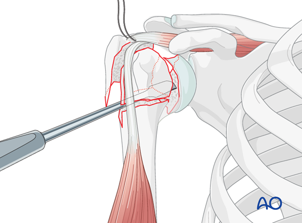 Reduce the humeral head split using digital pressure, periosteal elevators, and/or partially threaded pin(s) in either head ...