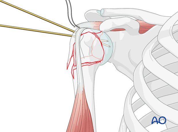 When anatomic, step-less reduction has been achieved, perform preliminary fixation with 2 or 3 K-wires.