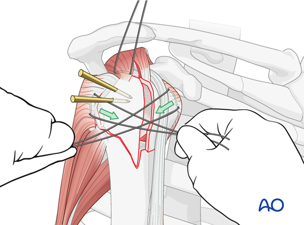 With the greater tuberosity properly reduced to the humeral head fragment, a defect remains into which the lesser tuberosity ...