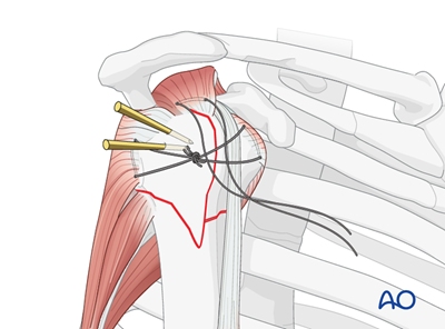 Orif - Plate Fixation For 4-part, Marked Displacement, Fragmentary 