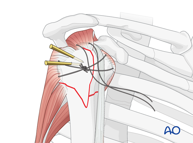 The horizontal suture between the infraspinatus and the subscapularis tendons closes the tuberosities underneath the humeral ...