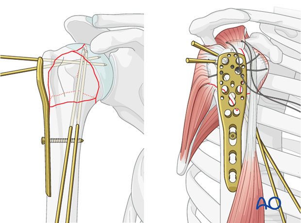 Attach the plate to the humeral shaft with a bicortical small fragment 3.5 mm screw inserted through the elongated hole.