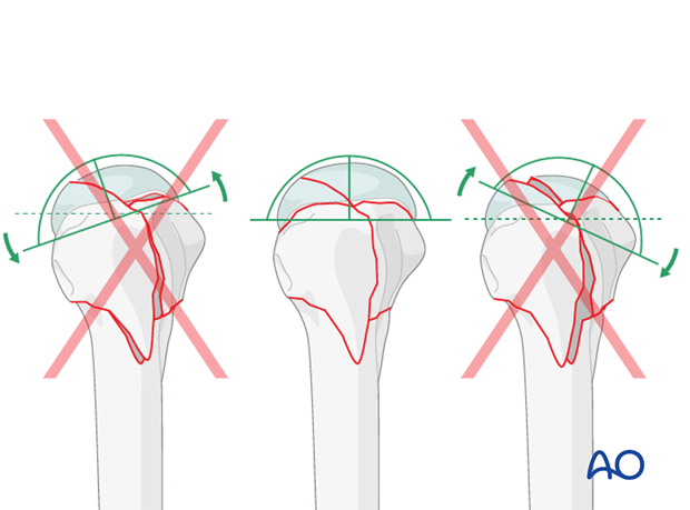 Check the position of the humeral head in the axial/lateral view and be sure that there is no anteversion or excessive ...
