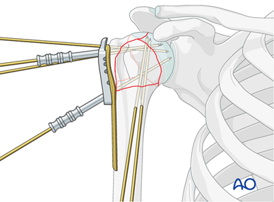 ORIF - Plate fixation for 4-Part, marked displacement, fragmentary ...
