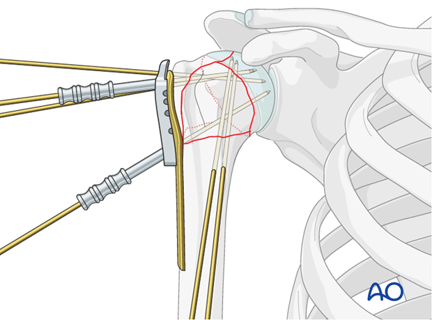Alternative provisional plate fixation: K-wires inserted through their appropriate K-wire sleeves.