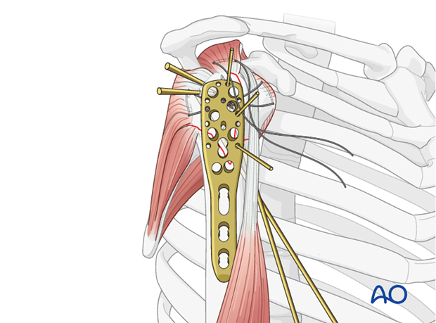 Preliminary plate fixation with K-wires