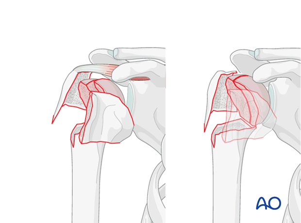 Anatomic (step-less) reduction of the humeral head fragments is key in this procedure.